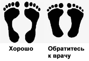 ортез для коррекции стопы